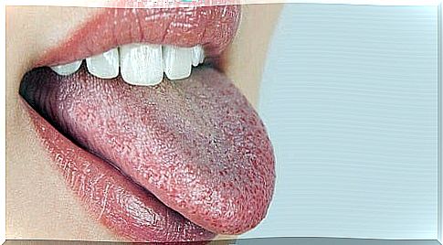 Tongue showing initial symptoms of diabetes