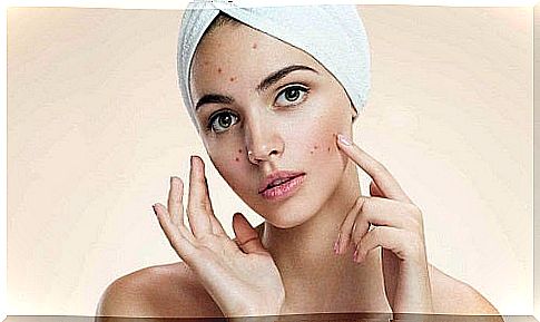 Acne removed with cosmetic tricks with apple cider vinegar