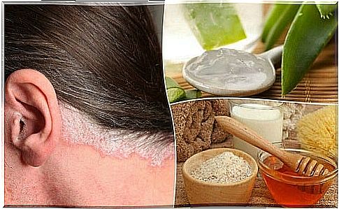 5 natural remedies for scalp psoriasis