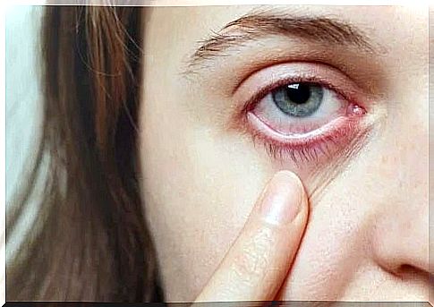 5 remedies for eye infections