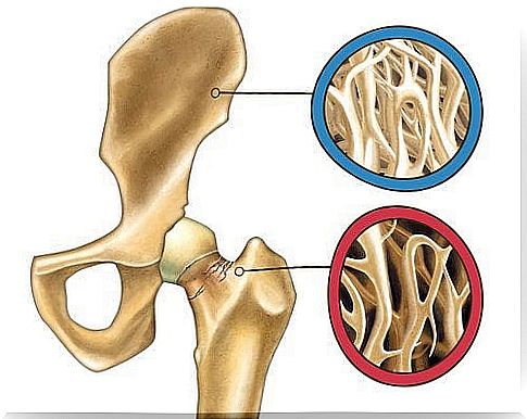 Bone fractures providing essential information about osteoporosis