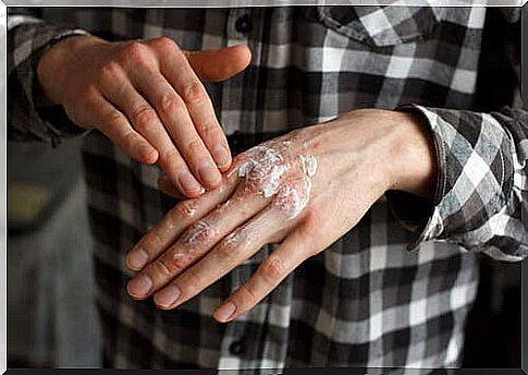 Patient trying to apply topical corticosteroids on his hand