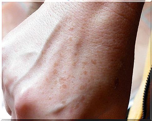 How to reduce the stains of old age and freckles on the hands