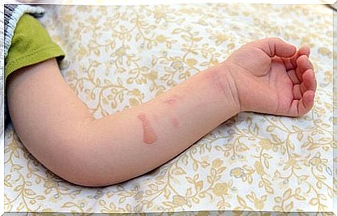 Second degree burn in a baby